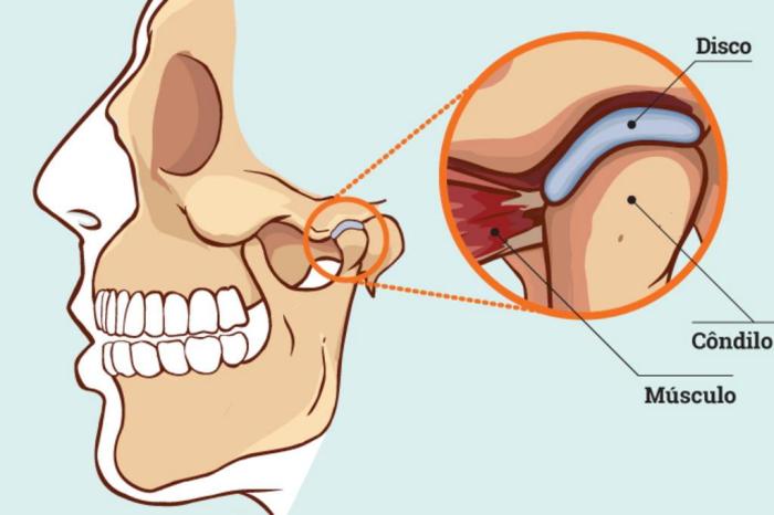 Doctus Premier Odontologia - O que é DTM? A articulação temporomandibular  (ATM) age como uma dobradiça, conectando o maxilar ao crânio. Esta  disfunção pode causar dor e desconforto. Dores na mandíbula, dificuldade