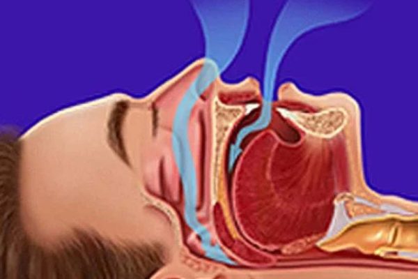 TRATAMENTO CIRÚRGICO DA APNEIA OBSTRUTIVA DO SONO (SAOS)​