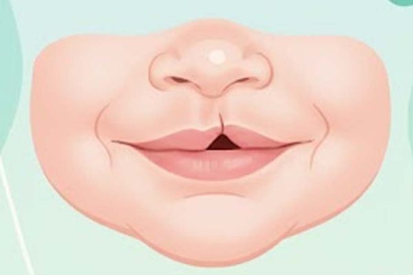 TRATAMENTO DE FISSURA LABIOPALATINA