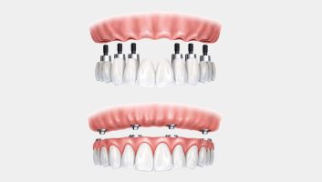 protese-dentaria-dentista-sao-paulo